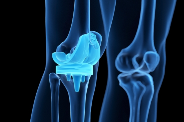 acibadem health point knee replacement